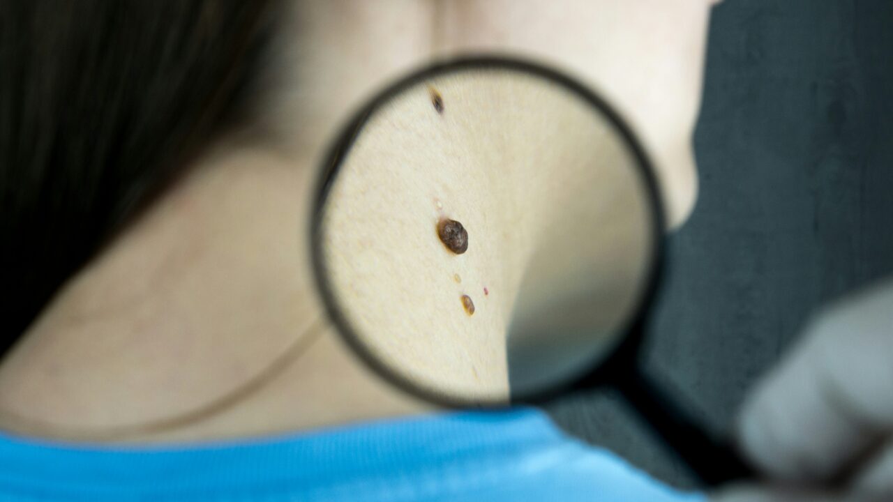 A magnifying glass overtop of a mole on a woman's neck