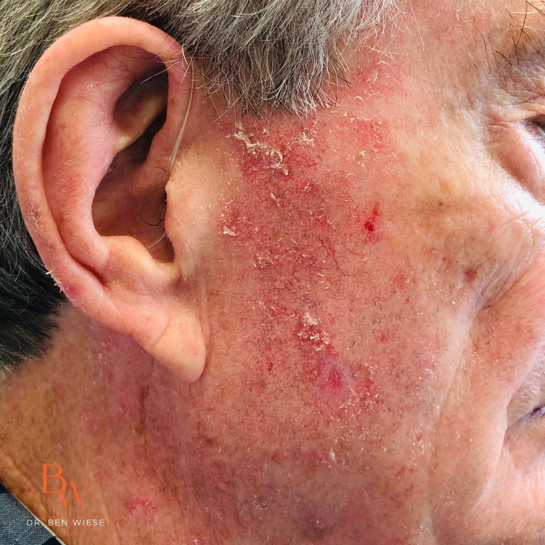 actinic keratosis kelowna