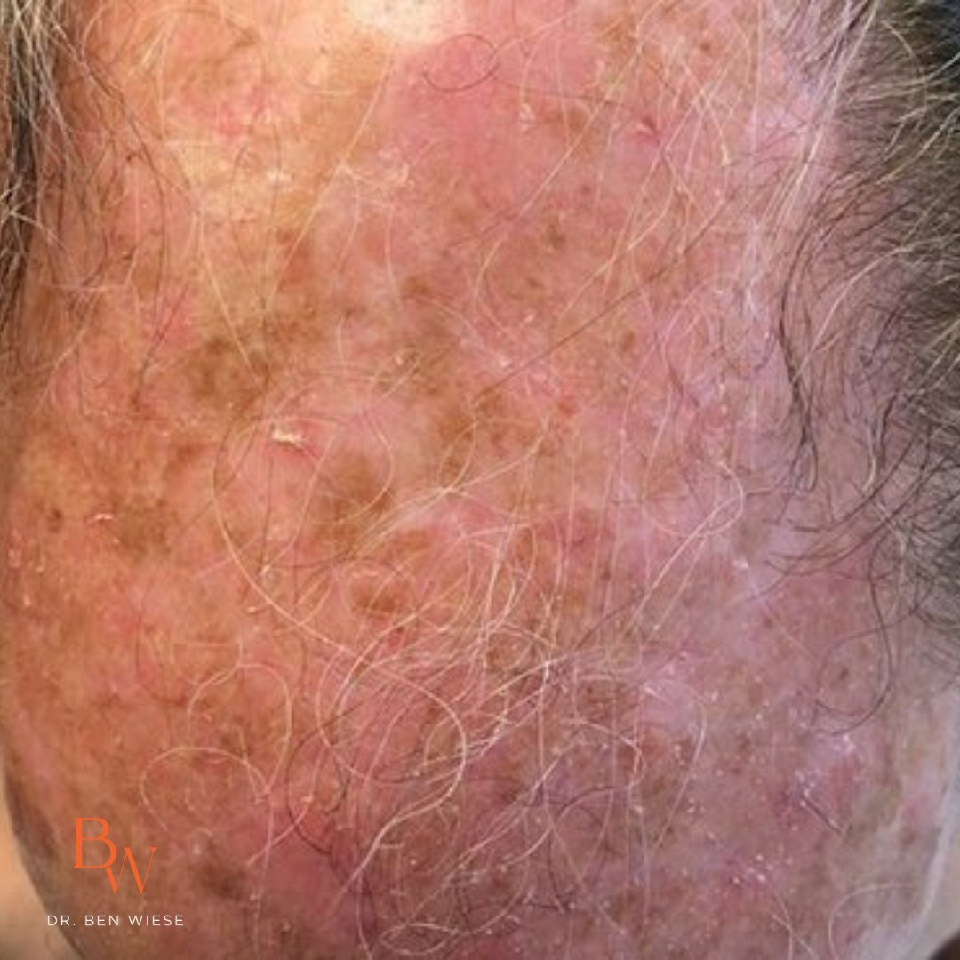 Up close image of actinic keratosis.