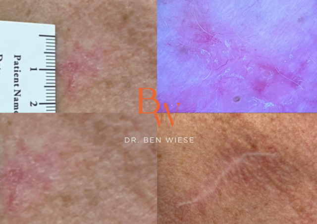  basal cell carcinoma kelowna