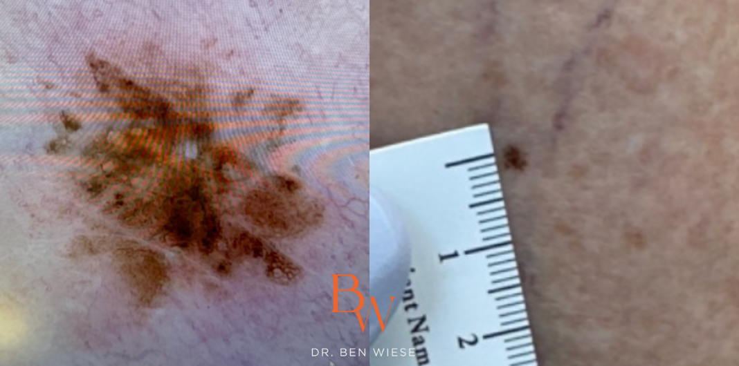 Early Evolving Melanoma in situ