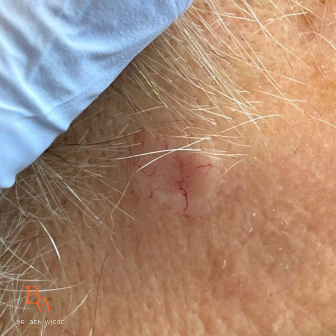 invasive micronodular basal cell carcinoma