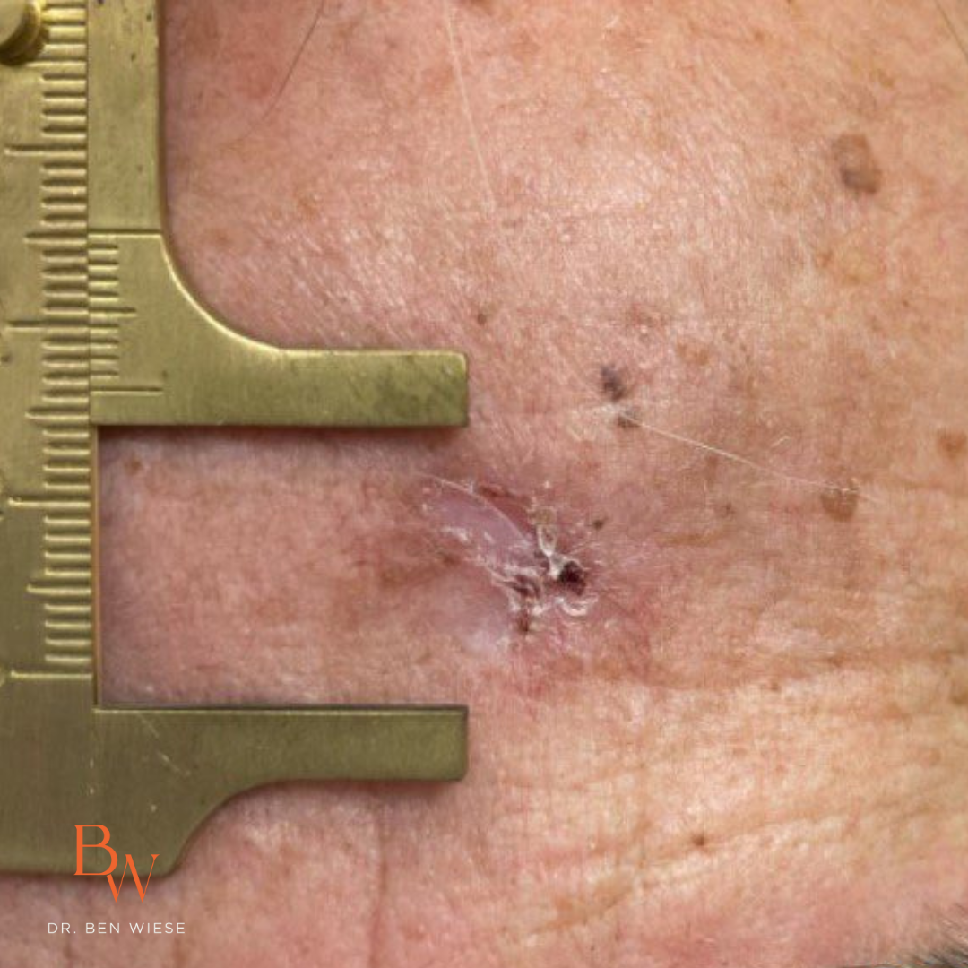 Up close image of nodular and infiltrative basal cell carcinoma with a measuring tool. 