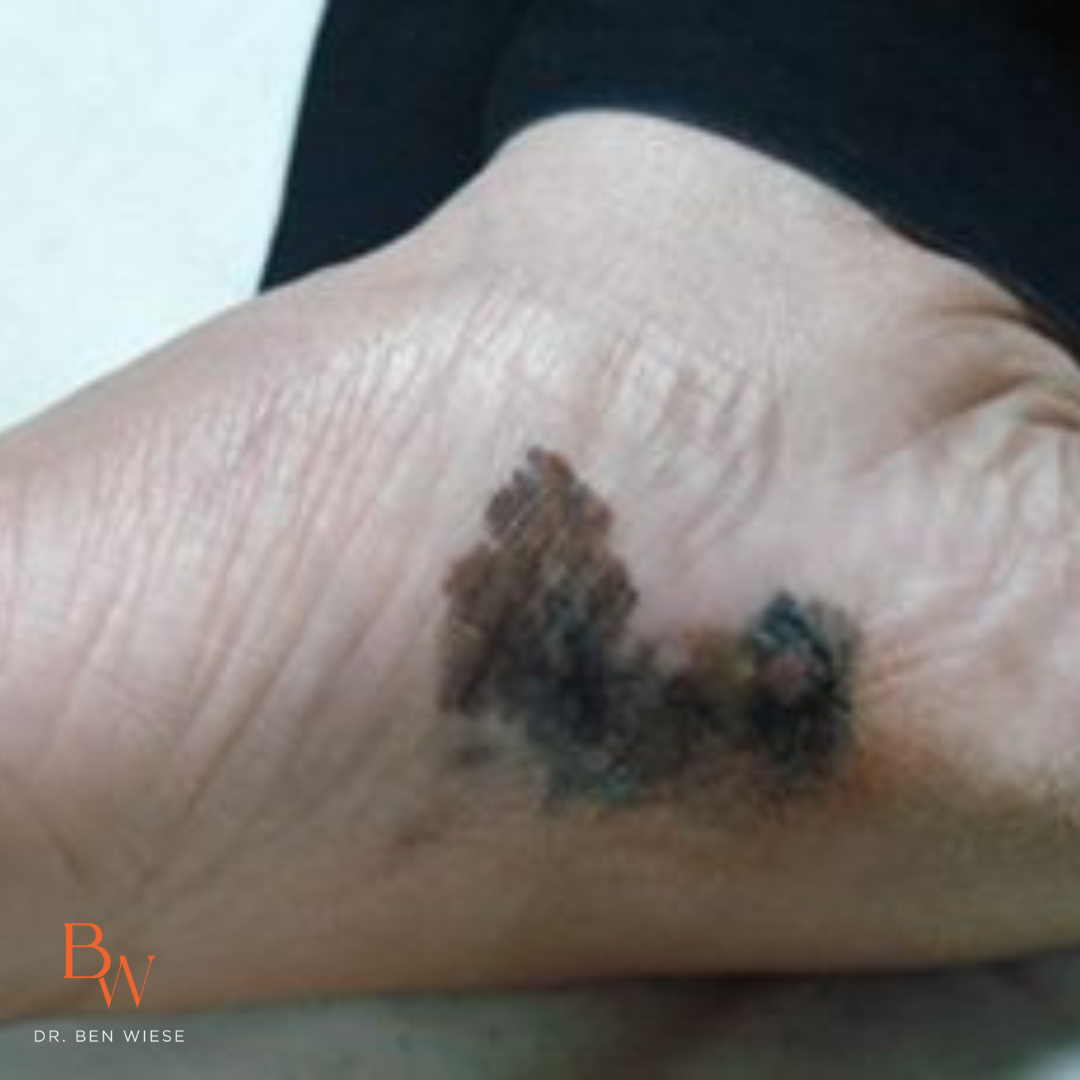 Melanoma Acral Lentiginous