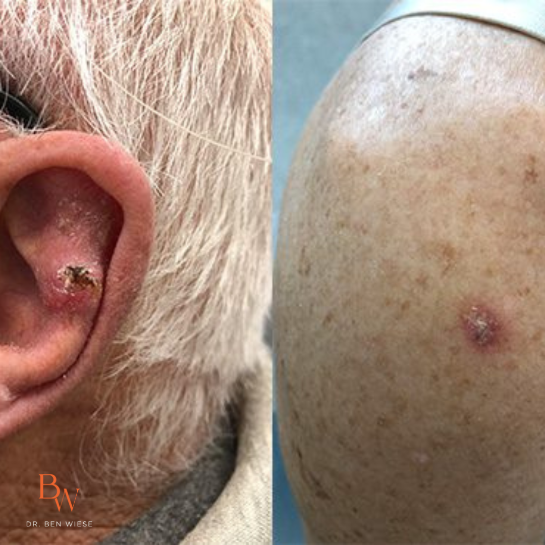 Two grid image of squamous cell carcinoma. Left image is of it on an ear, right is of it on the knee.