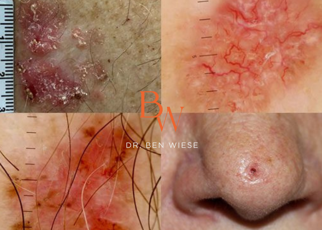 Four images in a grid of up-close images of basal cell carcinoma.