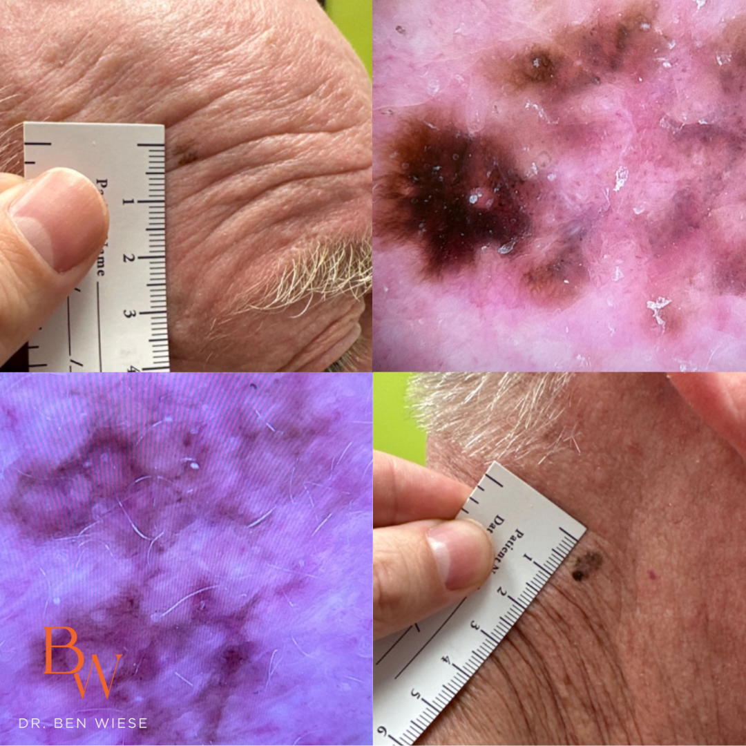 Melanoma in situ