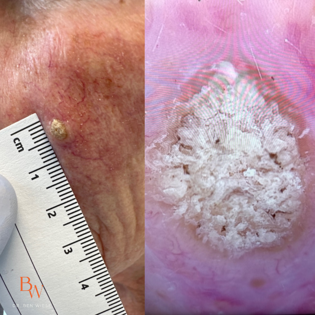 Two grid image of squamous cell carcinoma. Left image has a ruler to measure the size of it.