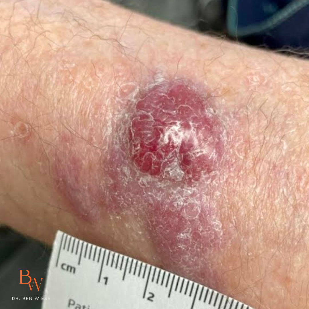 Image of merkel cell carcinoma on skin. 