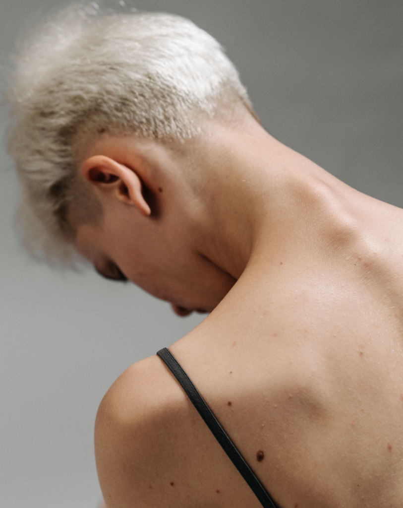 An image of a person's exposed shoulder, neck, and back with moles to showcase that sometimes we don't have to believe all the melanoma myths out there.