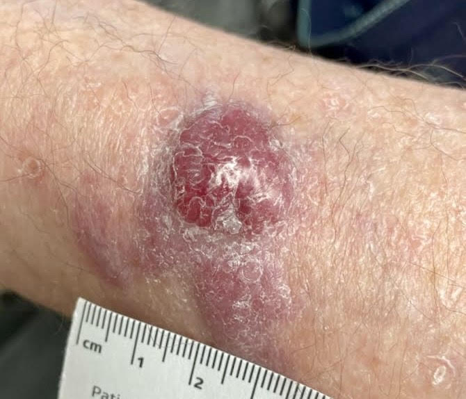 Image of merkel cell carcinoma on skin.